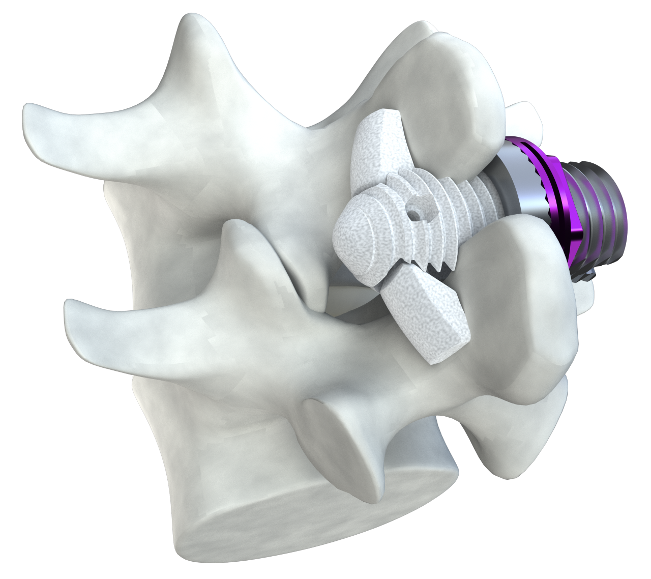 The Minuteman® Procedure in Palm Beach County Certified Spine & Pain Care